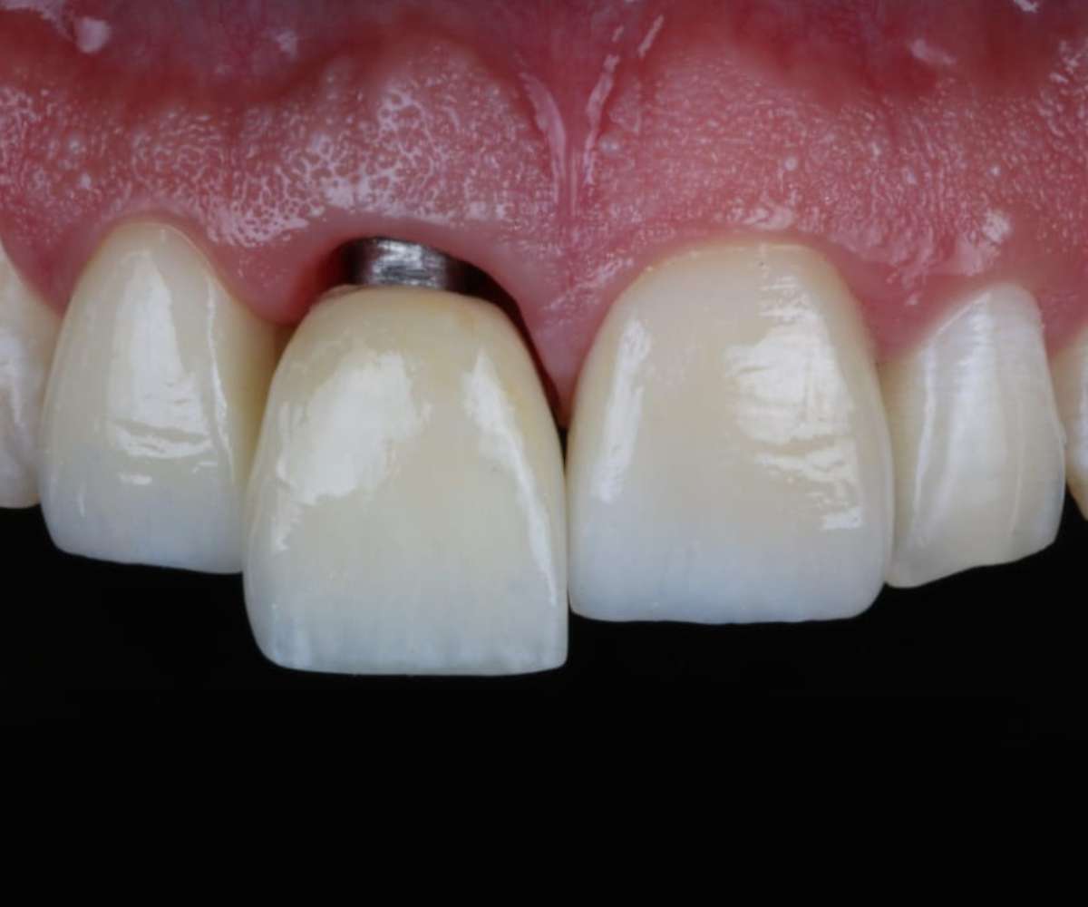 implantes dentales bucaramanga, especialistas en sonrisas